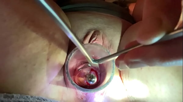Dilating to 9mm w Tenaculum and Hegar
